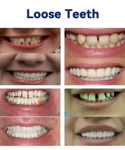 QIAWI ™-🦷Advanced Customized Full Denture Set