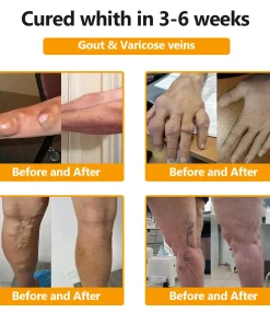 𝐒𝐓𝐃𝐄𝐈®𝐁𝐨𝐭𝐮𝐥𝐢𝐧𝐮𝐦 𝐓𝐨𝐱𝐢𝐧 & 𝐁𝐞𝐞 𝐕𝐞𝐧𝐨𝐦 𝐏𝐚𝐢𝐧-𝐑𝐞𝐥𝐢𝐞𝐟 𝐁𝐨𝐧𝐞 𝐇𝐞𝐚𝐥𝐢𝐧𝐠 𝐂𝐫𝐞𝐚𝐦