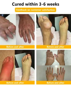 𝐒𝐓𝐃𝐄𝐈®𝐁𝐨𝐭𝐮𝐥𝐢𝐧𝐮𝐦 𝐓𝐨𝐱𝐢𝐧 & 𝐁𝐞𝐞 𝐕𝐞𝐧𝐨𝐦 𝐏𝐚𝐢𝐧-𝐑𝐞𝐥𝐢𝐞𝐟 𝐁𝐨𝐧𝐞 𝐇𝐞𝐚𝐥𝐢𝐧𝐠 𝐂𝐫𝐞𝐚𝐦