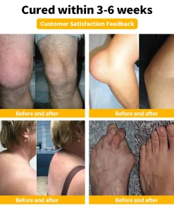 𝐋𝐎𝐕𝐈𝐋𝐃𝐒™ 𝐁𝐞𝐞 Poison 𝐀𝐝𝐯𝐚𝐧𝐜𝐞𝐝 𝐉𝐨𝐢𝐧𝐭 𝐚𝐧𝐝 𝐁𝐨𝐧𝐞 𝐓𝐡𝐞𝐫𝐚𝐩𝐲 𝐂𝐫𝐞𝐚𝐦