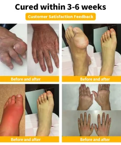 𝐋𝐎𝐕𝐈𝐋𝐃𝐒™ 𝐁𝐞𝐞 Poison 𝐀𝐝𝐯𝐚𝐧𝐜𝐞𝐝 𝐉𝐨𝐢𝐧𝐭 𝐚𝐧𝐝 𝐁𝐨𝐧𝐞 𝐓𝐡𝐞𝐫𝐚𝐩𝐲 𝐂𝐫𝐞𝐚𝐦