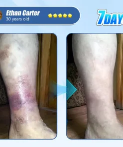 ADFIRE® Diabetic Skin Revolution