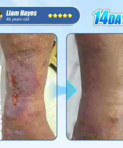 ADFIRE® Diabetic Skin Revolution