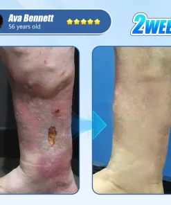 ADFIRE® Diabetic Skin Revolution