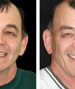 HZA™ Advanced Customized Full Denture Set