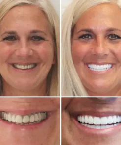 HZA™ Advanced Customized Full Denture Set