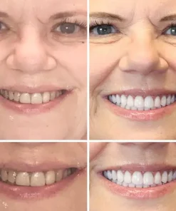 HZA™ Advanced Customized Full Denture Set