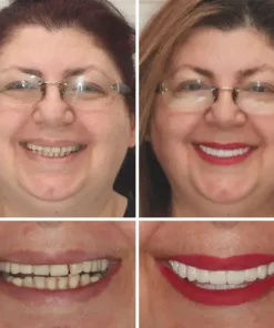 HZA™ Advanced Customized Full Denture Set