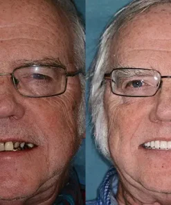 HZA™ --🦷Advanced Customized Full Denture Set🦷