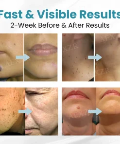 JEREMYTIS® Non-Invasive Mole and Wart Removal Laser Pen