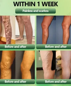 JORONDY® Horse Chestnut Vein Cream