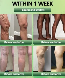 JORONDY® Horse Chestnut Vein Cream