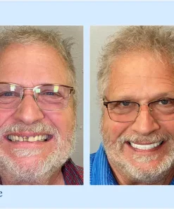 Neslemy™ - Premium Denture