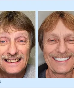 Neslemy™ - Premium Denture