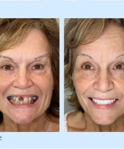 Neslemy™ - Premium Denture