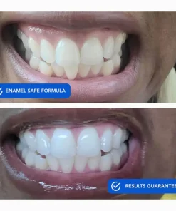 OneiasSmile™ Dissolvable Teeth Whitening Strips