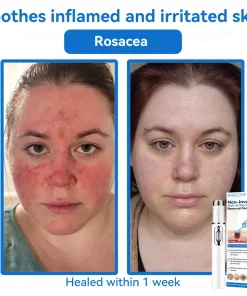 𝐉𝐚𝐬𝐬𝐞𝐞𝐦® 𝐍𝐨𝐧-𝐈𝐧𝐯𝐚𝐬𝐢𝐯𝐞 𝐌𝐨𝐥𝐞 & 𝐖𝐚𝐫𝐭 𝐋𝐚𝐬𝐞𝐫 𝐑𝐞𝐦𝐨𝐯𝐚𝐥 𝐏𝐞𝐧