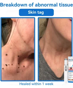 𝐉𝐚𝐬𝐬𝐞𝐞𝐦® 𝐍𝐨𝐧-𝐈𝐧𝐯𝐚𝐬𝐢𝐯𝐞 𝐌𝐨𝐥𝐞 & 𝐖𝐚𝐫𝐭 𝐋𝐚𝐬𝐞𝐫 𝐑𝐞𝐦𝐨𝐯𝐚𝐥 𝐏𝐞𝐧