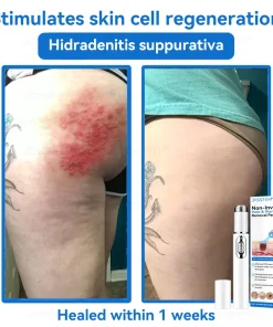 𝐉𝐚𝐬𝐬𝐞𝐞𝐦® 𝐍𝐨𝐧-𝐈𝐧𝐯𝐚𝐬𝐢𝐯𝐞 𝐌𝐨𝐥𝐞 & 𝐖𝐚𝐫𝐭 𝐋𝐚𝐬𝐞𝐫 𝐑𝐞𝐦𝐨𝐯𝐚𝐥 𝐏𝐞𝐧