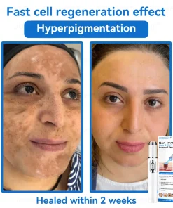 𝐉𝐚𝐬𝐬𝐞𝐞𝐦® 𝐍𝐨𝐧-𝐈𝐧𝐯𝐚𝐬𝐢𝐯𝐞 𝐌𝐨𝐥𝐞 & 𝐖𝐚𝐫𝐭 𝐋𝐚𝐬𝐞𝐫 𝐑𝐞𝐦𝐨𝐯𝐚𝐥 𝐏𝐞𝐧