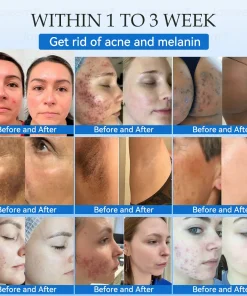 𝐉𝐚𝐬𝐬𝐞𝐞𝐦® 𝐍𝐨𝐧-𝐈𝐧𝐯𝐚𝐬𝐢𝐯𝐞 𝐌𝐨𝐥𝐞 & 𝐖𝐚𝐫𝐭 𝐋𝐚𝐬𝐞𝐫 𝐑𝐞𝐦𝐨𝐯𝐚𝐥 𝐏𝐞𝐧