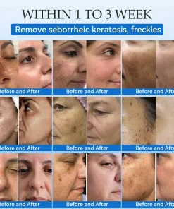 𝐉𝐚𝐬𝐬𝐞𝐞𝐦® 𝐍𝐨𝐧-𝐈𝐧𝐯𝐚𝐬𝐢𝐯𝐞 𝐌𝐨𝐥𝐞 & 𝐖𝐚𝐫𝐭 𝐋𝐚𝐬𝐞𝐫 𝐑𝐞𝐦𝐨𝐯𝐚𝐥 𝐏𝐞𝐧