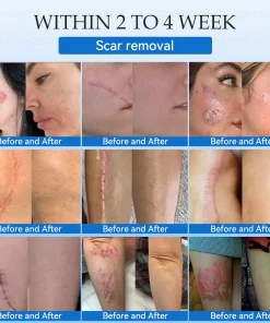 𝐉𝐚𝐬𝐬𝐞𝐞𝐦® 𝐍𝐨𝐧-𝐈𝐧𝐯𝐚𝐬𝐢𝐯𝐞 𝐌𝐨𝐥𝐞 & 𝐖𝐚𝐫𝐭 𝐋𝐚𝐬𝐞𝐫 𝐑𝐞𝐦𝐨𝐯𝐚𝐥 𝐏𝐞𝐧