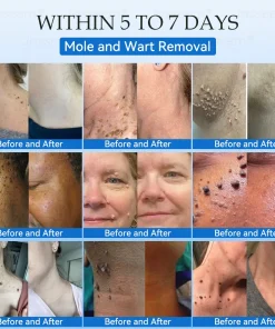 𝐉𝐚𝐬𝐬𝐞𝐞𝐦® 𝐍𝐨𝐧-𝐈𝐧𝐯𝐚𝐬𝐢𝐯𝐞 𝐌𝐨𝐥𝐞 & 𝐖𝐚𝐫𝐭 𝐋𝐚𝐬𝐞𝐫 𝐑𝐞𝐦𝐨𝐯𝐚𝐥 𝐏𝐞𝐧