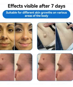 𝐉𝐚𝐬𝐬𝐞𝐞𝐦® 𝐍𝐨𝐧-𝐈𝐧𝐯𝐚𝐬𝐢𝐯𝐞 𝐌𝐨𝐥𝐞 & 𝐖𝐚𝐫𝐭 𝐋𝐚𝐬𝐞𝐫 𝐑𝐞𝐦𝐨𝐯𝐚𝐥 𝐏𝐞𝐧