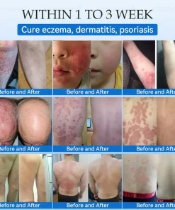 𝐉𝐚𝐬𝐬𝐞𝐞𝐦® 𝐍𝐨𝐧-𝐈𝐧𝐯𝐚𝐬𝐢𝐯𝐞 𝐌𝐨𝐥𝐞 & 𝐖𝐚𝐫𝐭 𝐋𝐚𝐬𝐞𝐫 𝐑𝐞𝐦𝐨𝐯𝐚𝐥 𝐏𝐞𝐧