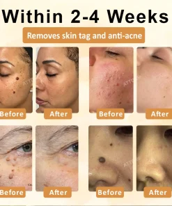 Cheemex™ CastorBee Tag & Spots Peel-Off Mask