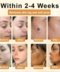 Cheemex™ CastorBee Tag & Spots Peel-Off Mask