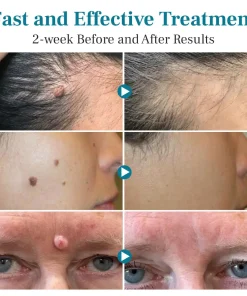 DAFEILA® LumeSkin Mole and Wart Removal Laser Pen