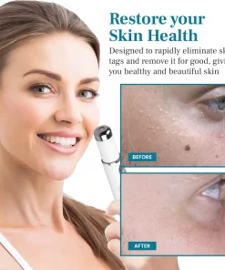 DAFEILA® LumeSkin Mole and Wart Removal Laser Pen