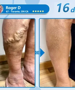 СΟRΟU® GLP-1 Nаnо Mісrоnееdlе Раtсh