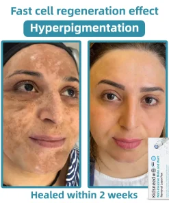 𝑲i𝒅sn𝒆𝒆𝒅® 𝑵on-i𝒏va𝒔𝒊ve 𝑴o𝒍e an𝒅 𝑾ar𝒕 𝑹emo𝒗𝒂𝒍 𝑳ase𝒓 𝑷en