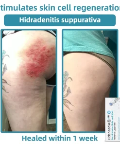 𝑲i𝒅sn𝒆𝒆𝒅® 𝑵on-i𝒏va𝒔𝒊ve 𝑴o𝒍e an𝒅 𝑾ar𝒕 𝑹emo𝒗𝒂𝒍 𝑳ase𝒓 𝑷en