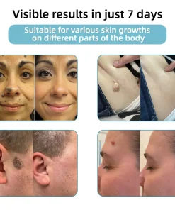 𝑲i𝒅sn𝒆𝒆𝒅® 𝑵on-i𝒏va𝒔𝒊ve 𝑴o𝒍e an𝒅 𝑾ar𝒕 𝑹emo𝒗𝒂𝒍 𝑳ase𝒓 𝑷en