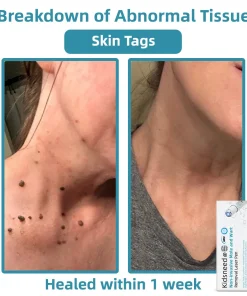 𝑲i𝒅sn𝒆𝒆𝒅® 𝑵on-i𝒏va𝒔𝒊ve 𝑴o𝒍e an𝒅 𝑾ar𝒕 𝑹emo𝒗𝒂𝒍 𝑳ase𝒓 𝑷en