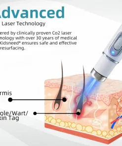 𝑲i𝒅sn𝒆𝒆𝒅® 𝑵on-i𝒏va𝒔𝒊ve 𝑴o𝒍e an𝒅 𝑾ar𝒕 𝑹emo𝒗𝒂𝒍 𝑳ase𝒓 𝑷en