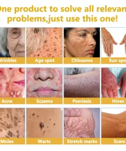 𝑭𝑨𝑻𝑶𝑵𝑮® 𝑩𝒆𝒆 𝑽𝒆𝒏𝒐𝒎 𝑺𝒌𝒊𝒏 𝑻𝒓𝒆𝒂𝒕𝒎𝒆𝒏𝒕 𝑬𝒔𝒔𝒆𝒏𝒄𝒆 𝑨𝒎𝒑𝒐𝒖𝒍𝒆𝒔