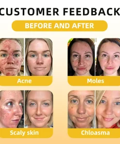 𝑭𝑨𝑻𝑶𝑵𝑮® 𝑩𝒆𝒆 𝑽𝒆𝒏𝒐𝒎 𝑺𝒌𝒊𝒏 𝑻𝒓𝒆𝒂𝒕𝒎𝒆𝒏𝒕 𝑬𝒔𝒔𝒆𝒏𝒄𝒆 𝑨𝒎𝒑𝒐𝒖𝒍𝒆𝒔