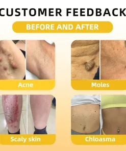 𝑭𝑨𝑻𝑶𝑵𝑮® 𝑩𝒆𝒆 𝑽𝒆𝒏𝒐𝒎 𝑺𝒌𝒊𝒏 𝑻𝒓𝒆𝒂𝒕𝒎𝒆𝒏𝒕 𝑬𝒔𝒔𝒆𝒏𝒄𝒆 𝑨𝒎𝒑𝒐𝒖𝒍𝒆𝒔