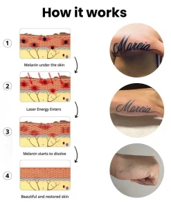 BubblPro™: Picosecond Laser Tattoo Removal