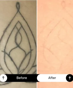 BubblPro™: Picosecond Laser Tattoo Removal