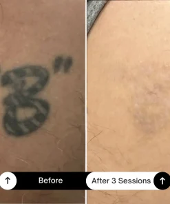 BubblPro™: Picosecond Laser Tattoo Removal