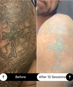 BubblPro™: Picosecond Laser Tattoo Removal