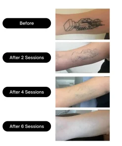 BubblPro™: Picosecond Laser Tattoo Removal