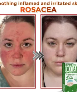 DermaPatchRX® MicroNeedle Botanic Skin Tag Removal Patch