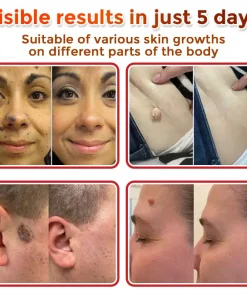 DermaPatchRX® MicroNeedle Botanic Skin Tag Removal Patch